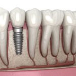 Dental Implants Hertfordshire – Find Your Invisalign Dentist Near Me