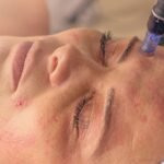 Microneedling Treatment Surrey BC: Benefits, Process & Skin Care Guide