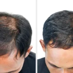 Laser Hair Reduction Treatment in Guwahati – Modern Laser Technology for Smooth, Hair-Free-Looking Skin | Essence Skin Care
